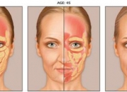 自体脂肪填充太阳穴能让额头变宽吗？