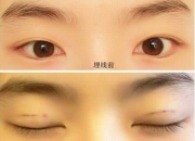 玉器纳米无痕修复,纳米无痕和埋线，有什么不一样？